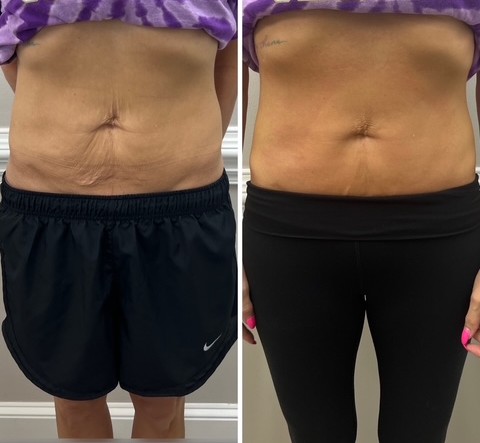 CRYOBA20262 NEVESKIN BODY SCULPTING CRYO TONING