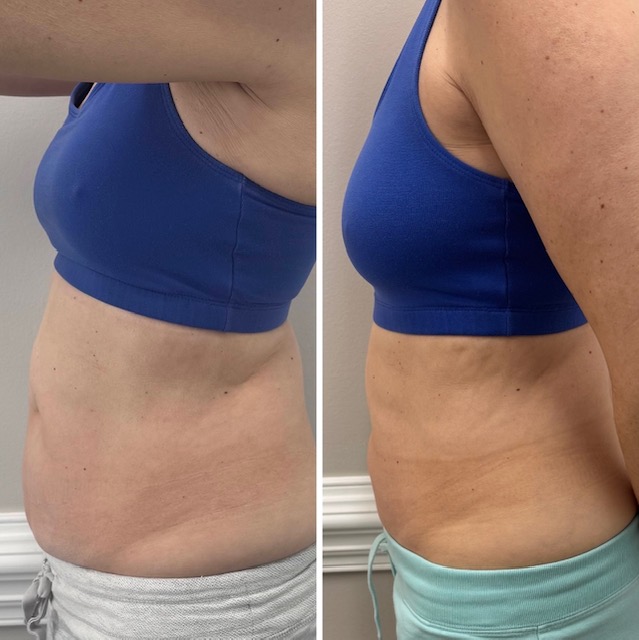 CryoBA NEVESKIN CRYOSCUPTING BELLY FAT